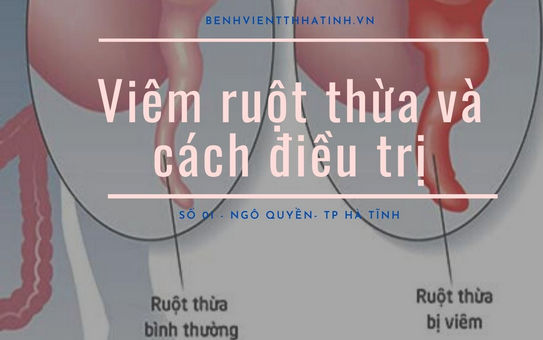 Viêm ruột thừa và cách điều trị hiệu quả