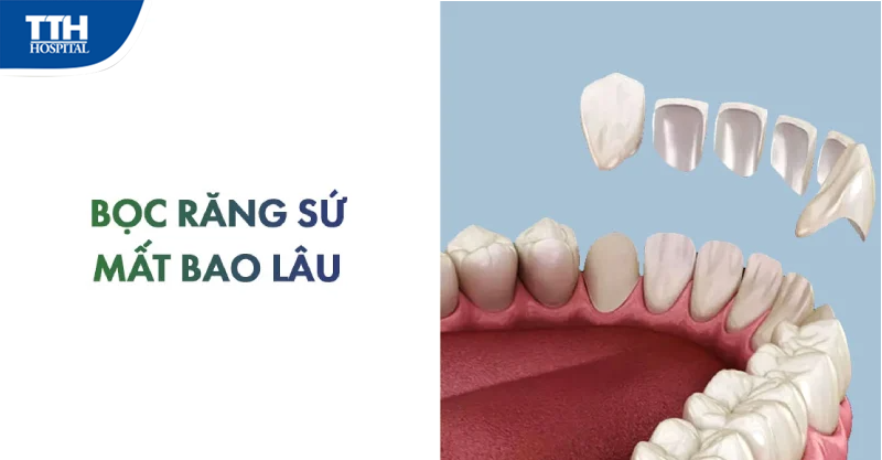 LÀM RĂNG SỨ MẤT BAO LÂU THÌ XONG?