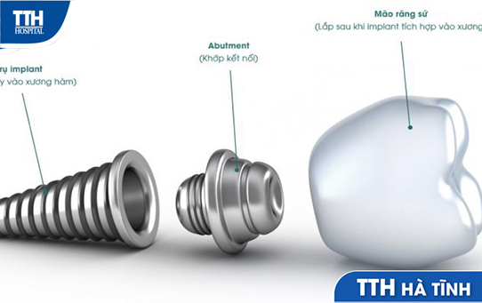 CẮM TRỤ IMPLANT VÀ NHỮNG ĐIỀU CẦN BIẾT