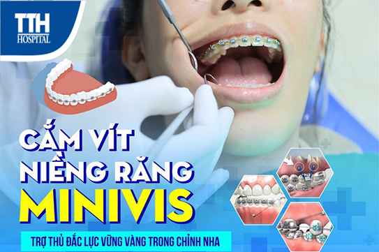 Cắm vít niềng răng