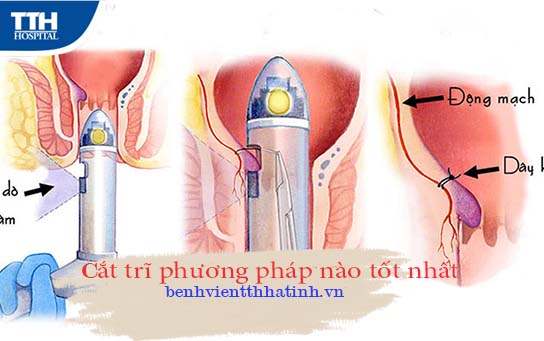 Cắt trĩ bằng phương pháp nào tốt nhất