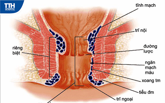 Phẫu thuật trĩ không còn là nỗi lo của người bệnh