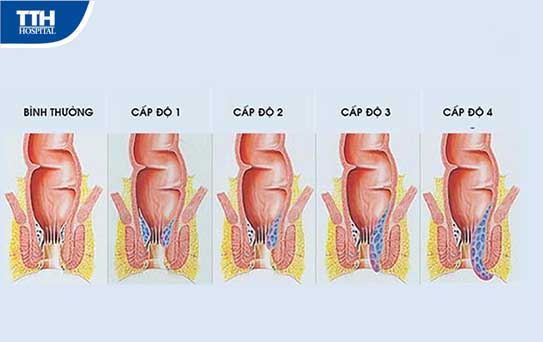 Cắt trĩ bằng phương pháp longgo và những điều cần biết