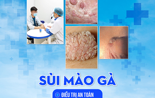 Biểu hiện và cách điều trị bệnh sùi mào gà