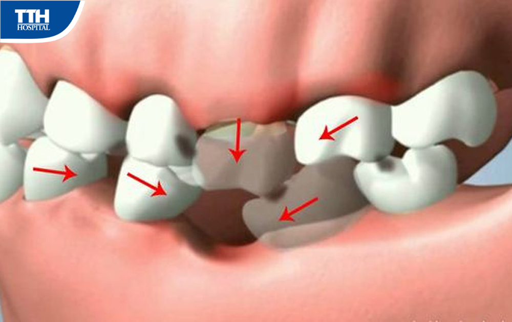 Sự khác biệt giữa trồng răng Implant và làm răng giả thông thường