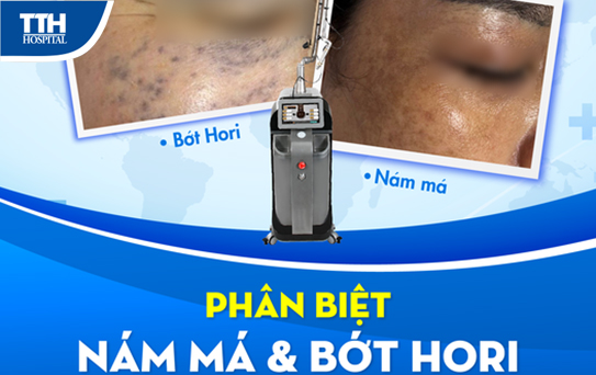 Phân biệt nám má và bớt hori