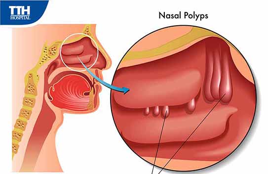 Chấm dứt nấm xoang bướm - polyp xoang hàm lâu năm