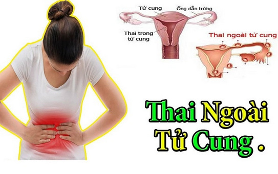 Thai ngoài tử cung