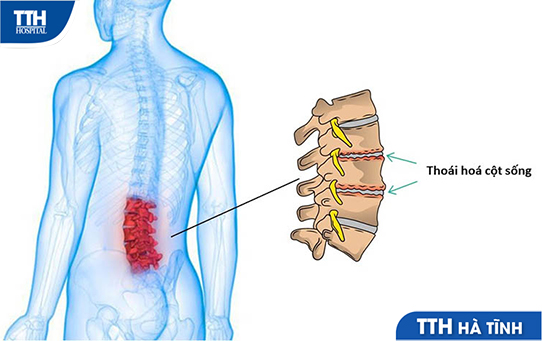 thoái hóa cột sống thắt lưng