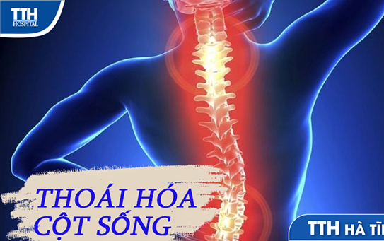 Tìm hiểu về bệnh thoái hóa cột sống