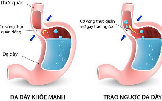 Bệnh trào ngược dạ dày thực quản và những điều cần biết