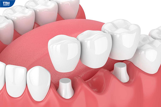 Nên trồng răng bằng cầu răng hay cấy ghép implant