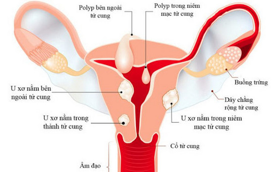 Giải đáp thắc mắc - Cắt u xơ tử cung có thai được không?